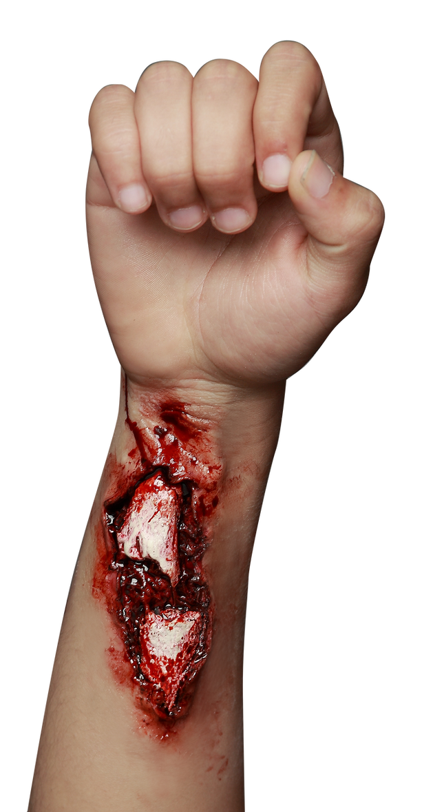 Appliance - Broken Arm