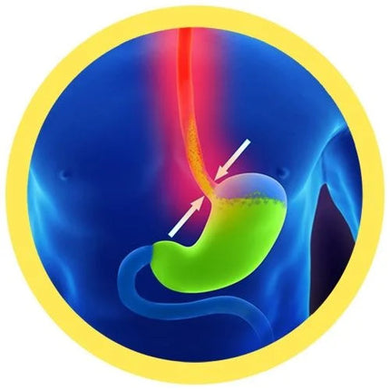 acid reflux illustration