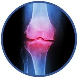 arthritis illustration