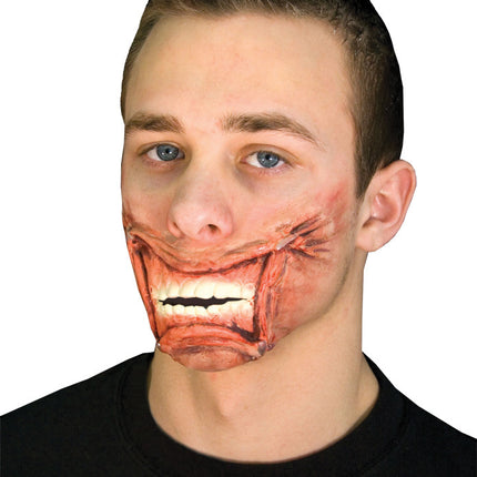 Stapled Mouth Appliance