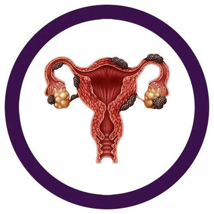 Endometriosis- illustration