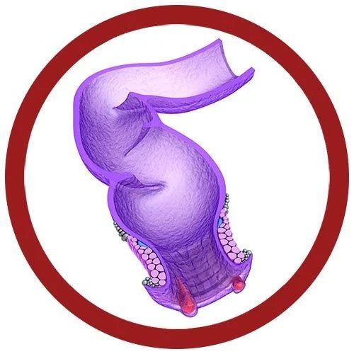 Hemorrhoid illustration