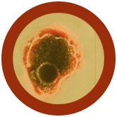 Herpes zoster