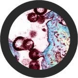 HIV/ Human Immunodeficiency Virus- Under the Microscope