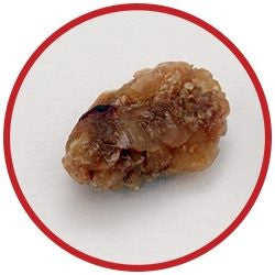 Real Kidney Stone